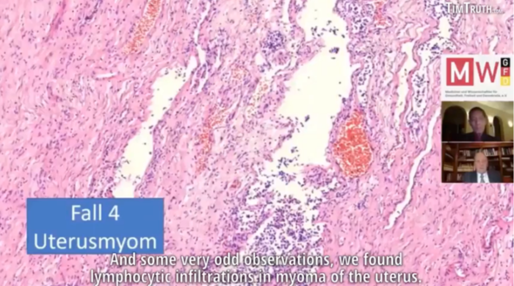 lymphocytic infiltration of muscle layer