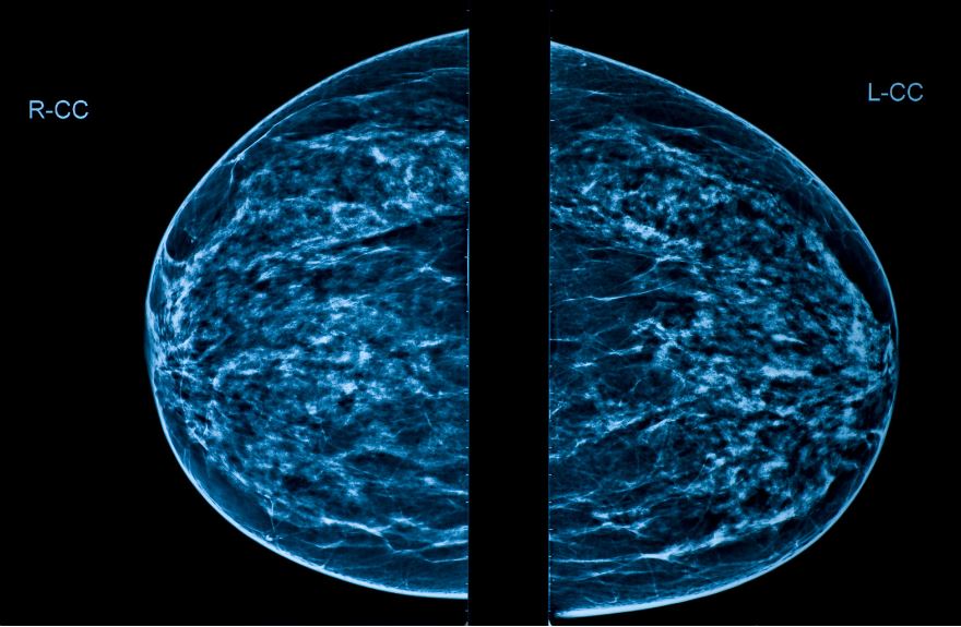 Inflamed Lymph Nodes, Bright Spots in Mammogram Following MRNA Vaccine