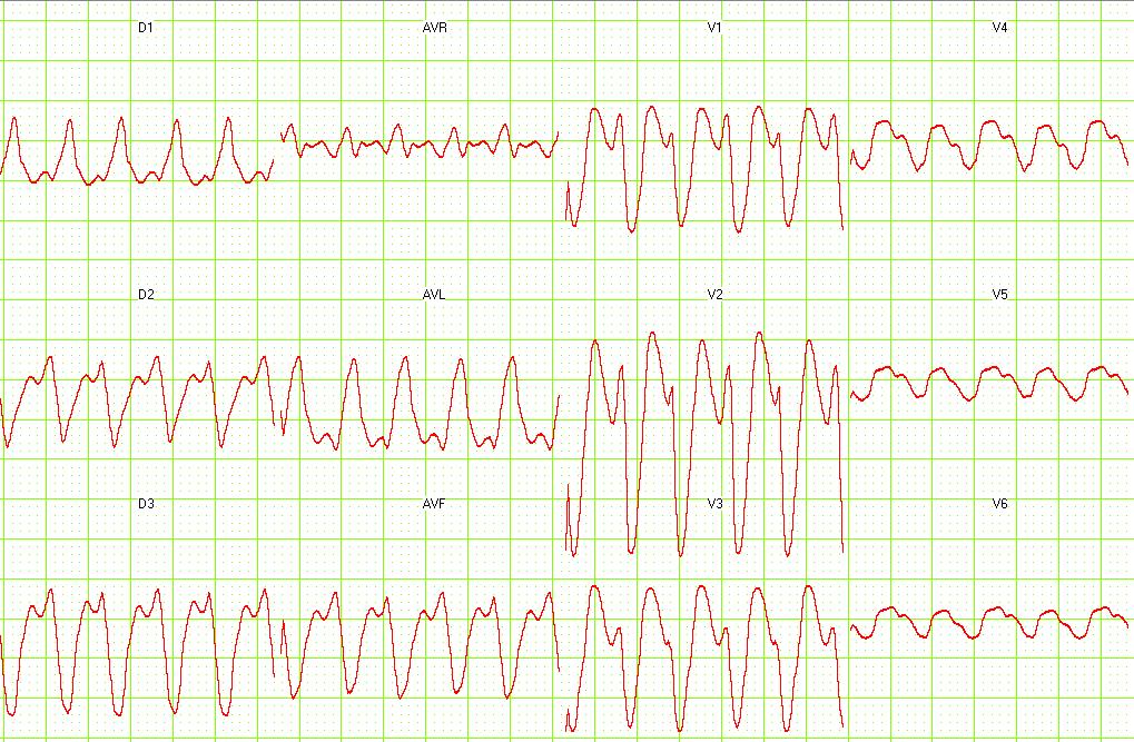 tachycardia